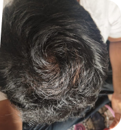 After 7 Months of treatment – Amit Sharma