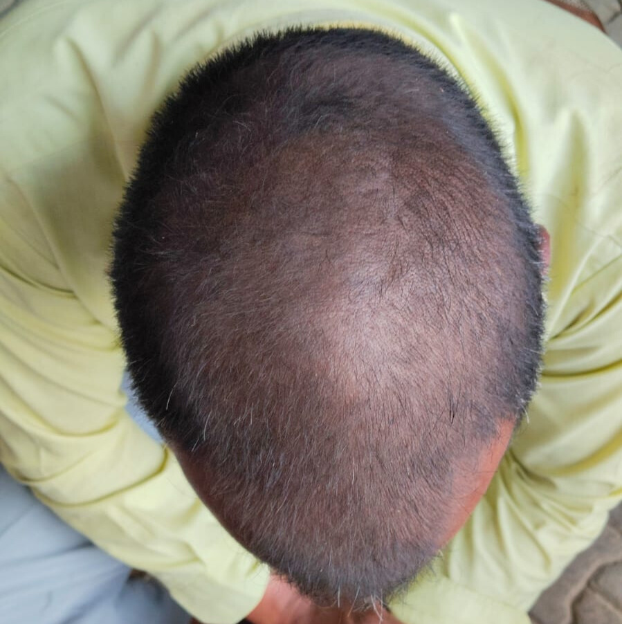 After 4 Months of treatment – Rohit Verma