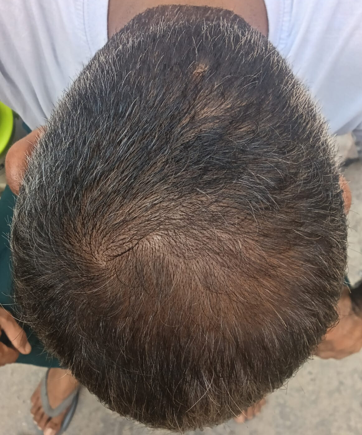 After 6 Months of treatment – Sandeep Malhotra