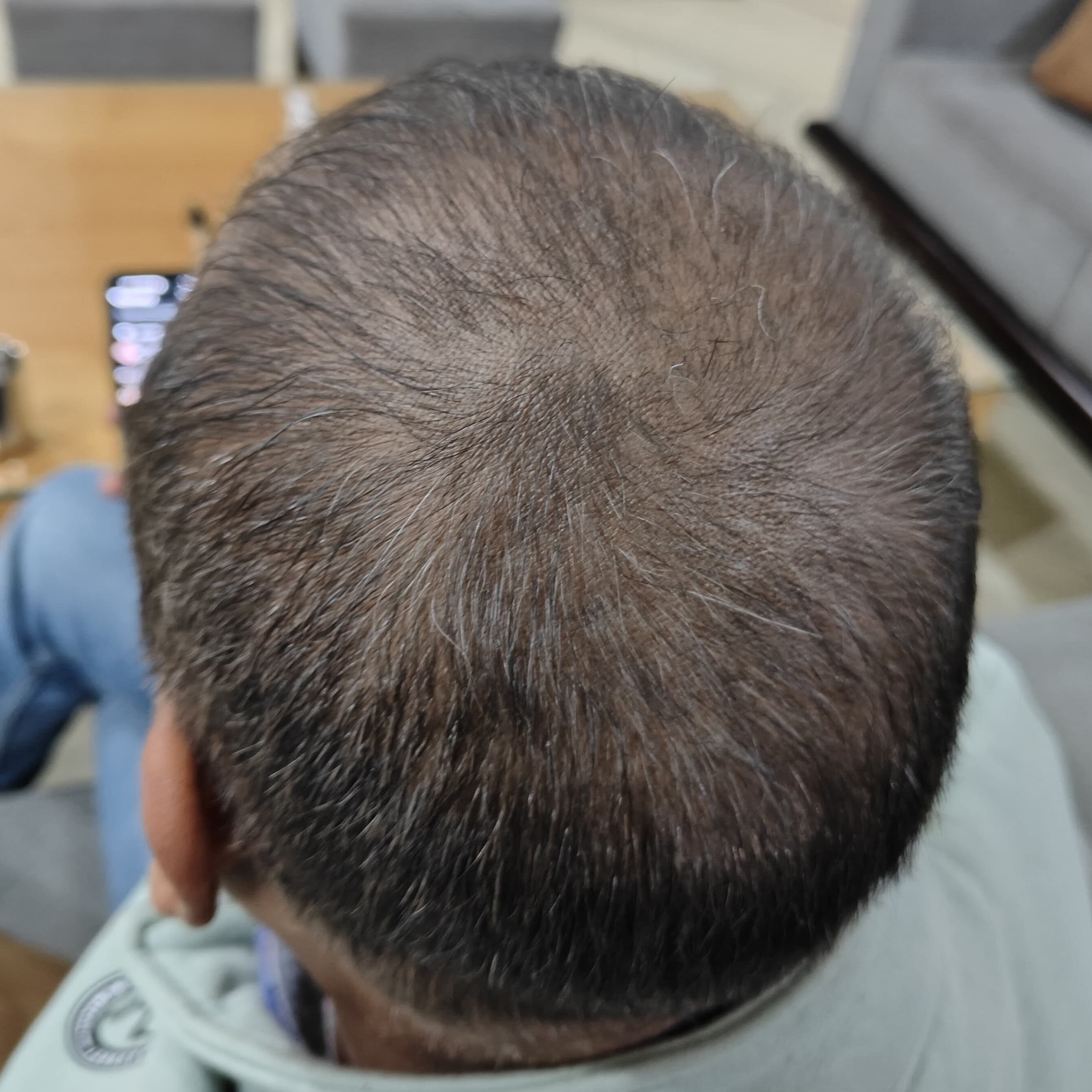 After 4 Months of treatment – Dinesh Kumar