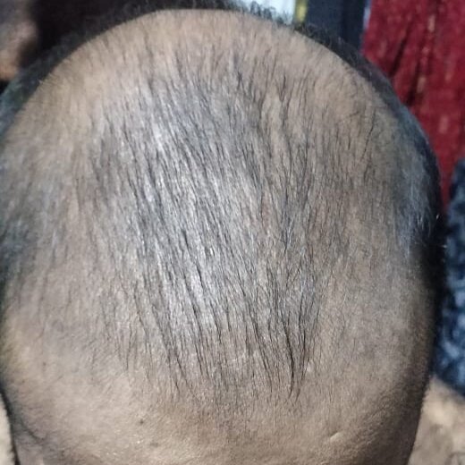 After 2 Months of treatment – Ankit Gupta