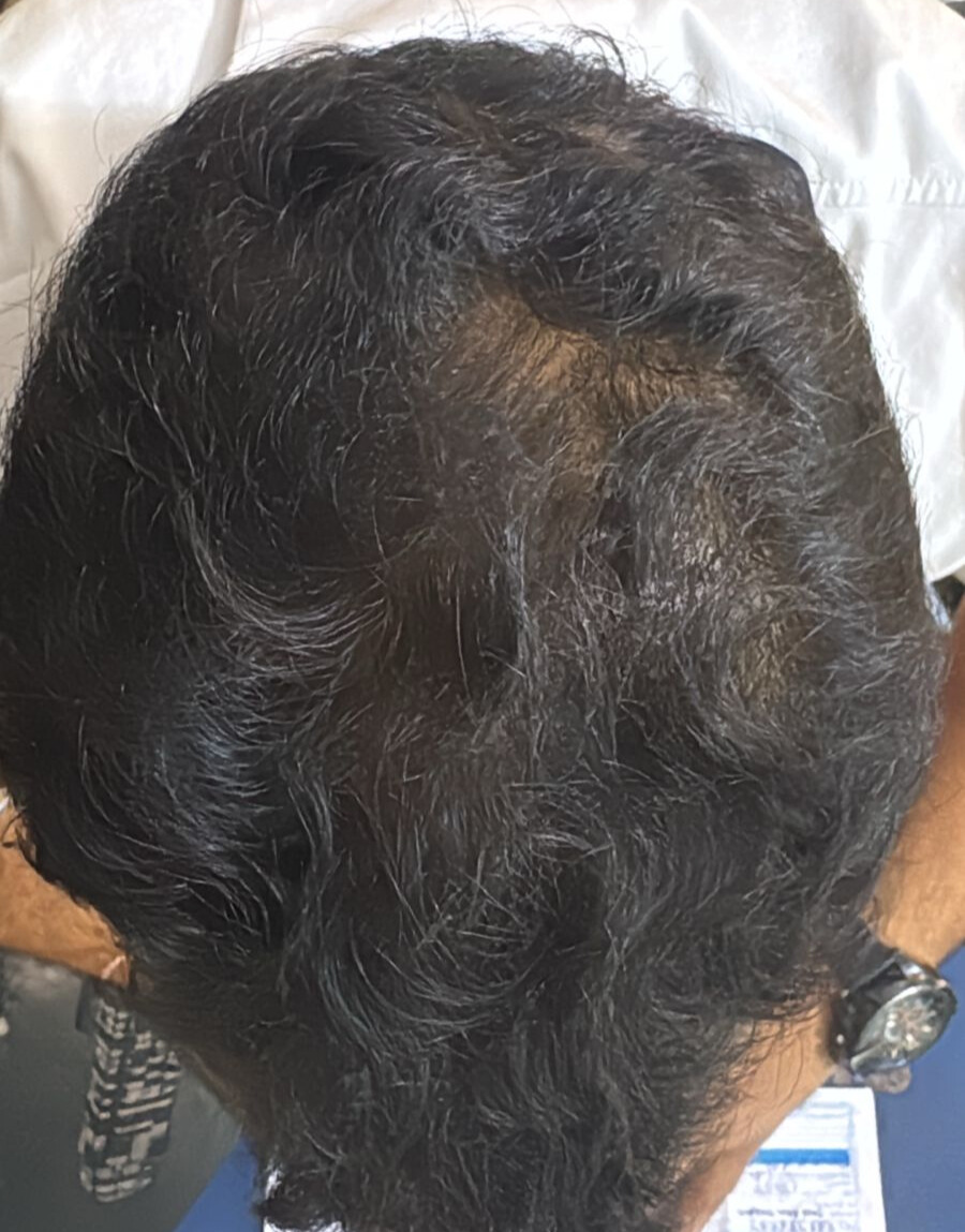 After 5 Months of treatment – Praveen Saini