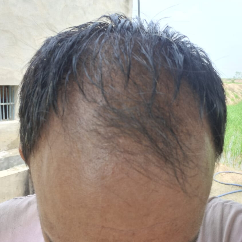 After 2 Months of treatment – Kunal Mehta