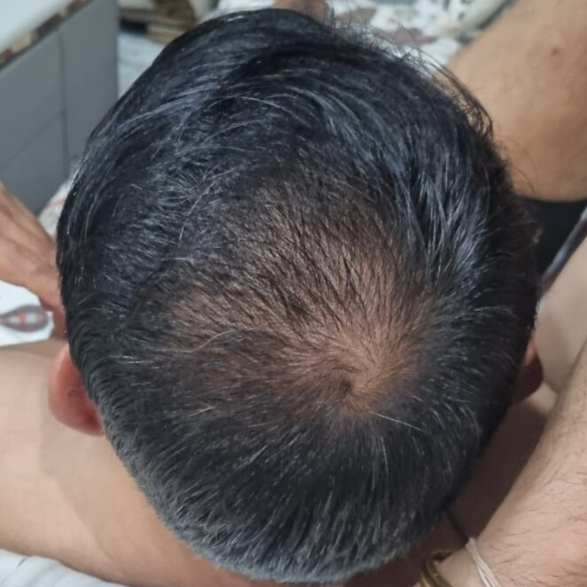 After 3 Months of treatment – Rajeev Nair