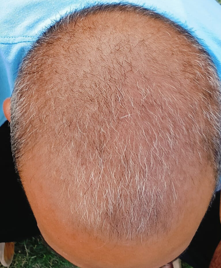 Before treatment – Sandeep Malhotra