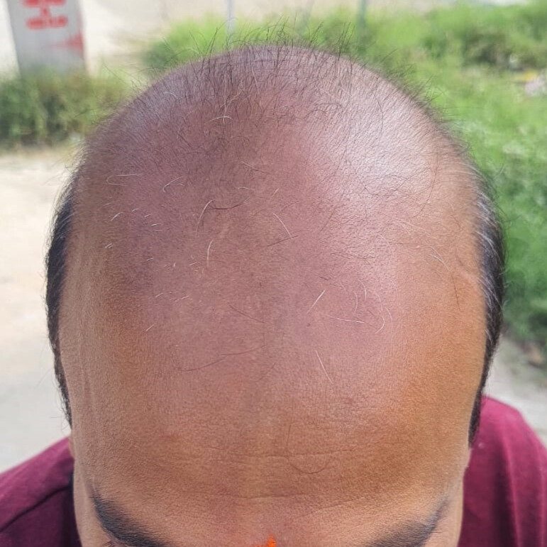 Before treatment – Dinesh Kumar