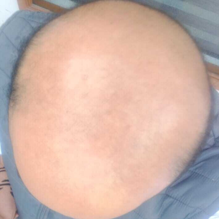 Before treatment – Ankit Gupta