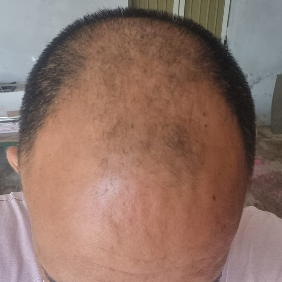 Before treatment – Kunal Mehta